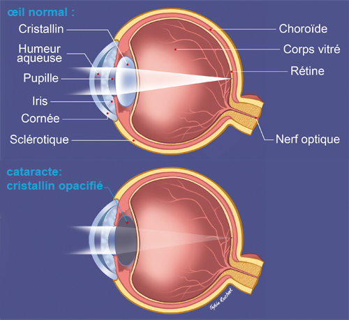 Œil normal / Cataracte