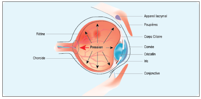 Glaucome