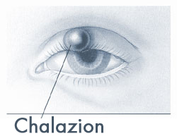 chalazion