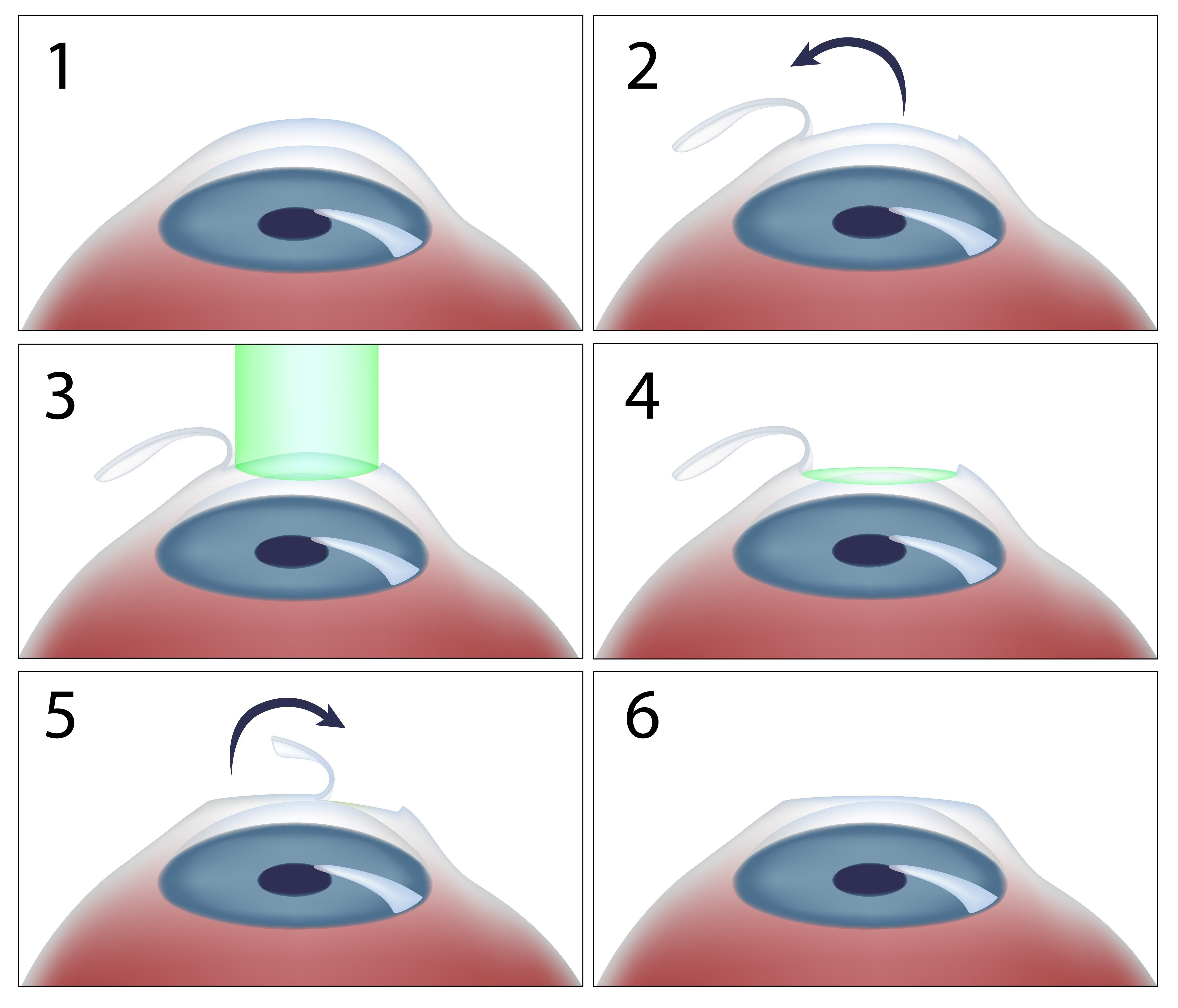 Лазерная коррекция зрения 2024. Операция супер ласик на глаза. Ласик коррекция зрения технология. Эксимер-лазерная коррекция астигматизма.